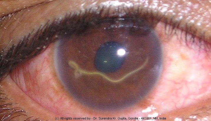 Worm In Human Eye